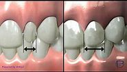Peg Lateral Incisors