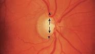 Normal Optic Disc Appearance