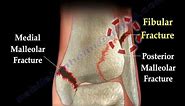 Ankle fracture / Fractures and its repair- Everything You Need To Know - Dr. Nabil Ebraheim