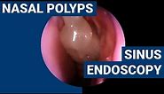 Nasal polyps | PHACON Sinus Patient Meyer
