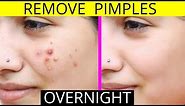 How To Remove Pimples Overnight | Acne Treatment | Anaysa