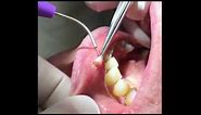 Fibroma Removal procedure with Picasso Dental Laser by Dr. Sonkin