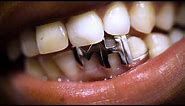 Grills: jewellery for your teeth