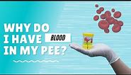Blood In Urine / Why do I have Blood In My Pee?