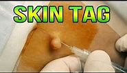 Skin Tag Removal - Dr G Snips Off an Under Arm Papilloma