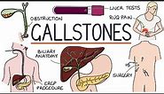 Understanding Gallstones