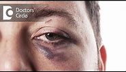 What is Black Eye & its treatment? - Dr. Sriram Ramalingam