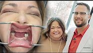Natural Teeth Restored Even with Bone Loss using 3 on 6 Implant Bridges