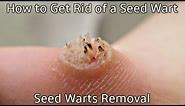 How to Get Rid of a Seed Wart - Seed Warts Removal