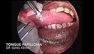 Tongue Papilloma | Treatment | Surgical Excision |