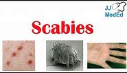 Scabies (Skin Condition) | What Is It, Classic vs. Crusted Types, Signs & Symptoms, Treatment