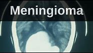 What is a Meningioma? Pathology mini tutorial