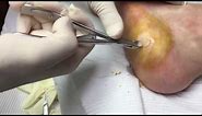 Wart removal surgery