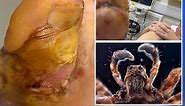 Wolf spider lays eggs in man’s toe, baby hatches inside: ‘Eating its way out’
