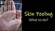 What causes skin peeling from fingers and feet? How to manage? - Dr. Rasya Dixit