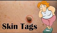 Skin Tags (Acrochordon) - Causes, Signs & Symptoms, And Treatment