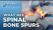 What Are Spinal Bone Spurs? | Spinal Osteophytes