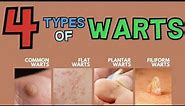 THE 4 MAIN TYPES OF WARTS!