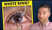 Corneal Arcus - What Is That White, Gray Ring In Your Eye? (Arcus Senilis VS Arcus Juvenilis)