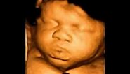 What is 4D ultrasound scan?