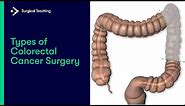 Types of Colorectal Cancer Surgery | What are the Different Operations We Can Perform?