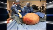 Woman's 140-Pound Tumor Removed