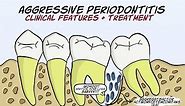 Aggressive Periodontitis (Part 2) - Clinical features and treatment