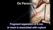 Peroneus Longus Tendon Rupture Os Peroneum Injury - Everything You Need To Know - Dr. Nabil Ebraheim