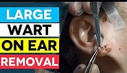 You Never Saw Such a Large Wart on The Ear (Removal)