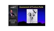 Humeral Fracture Repair: Percutaneous Pinning and SuturePlate™