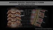 Anterior Cervical Discectomy & Fusion at C3-4, C4-5 & C5-6