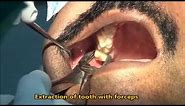 Upper wisdom tooth extraction with forceps
