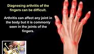 Arthritis Of The Fingers - Everything You Need To Know - Dr. Nabil Ebraheim