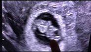 Sonogram: 9 weeks pregnant!