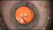 Correction of Astigmatism with Toric Intraocular Lens during cataract surgery- See Better!