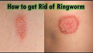 Ringworm Treatment At Home : 7 Steps on How to Cure Ringworm Fast!