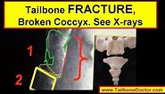 X-rays showing COCCYX FRACTURE (broken tailbone)