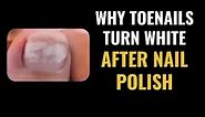 WHITE Toenails after Nail Polish - QUICK TREATMENT FROM PODIATRIST