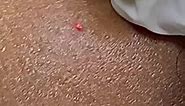 Laser wart removal treatment. Laser... - LUSH Skin Clinic