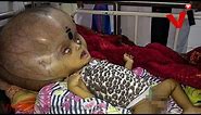 Baby With ‘World’s Largest Head’ Has Life Saving Surgery To Remove 8 Pounds Of Fluids From Skull