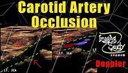 Carotid Artery Occlusion || Doppler || Ultrasound || Case 266