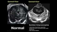Fetal Brain Ultrasound Normal Vs Abnormal Image Appearances Comparison | Fetal Brain Pathologies USG
