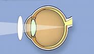 Retinoscopy of the eye (Ophthalmology)