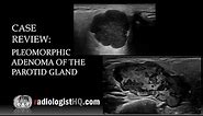 Ultrasound of Pleomorphic Adenoma of the Parotid Gland