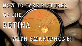 Retinal photography with smartphone
