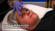 HydraFacial™ Demonstration from Skin Blends