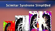 Scimitar Syndrome - 3D CT