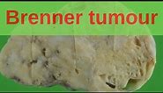 Brenner Tumour of the Ovary - Pathology mini tutorial