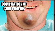 Chin Zits! Chin Blackheads, Chin Pimples and Pimple Pops!