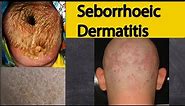 Seborrhoeic dermatitis - Explained under 3 minutes. Seborrheic dermatitis Symptoms and treatment